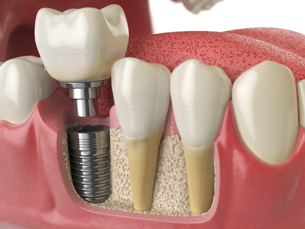 Dental Tooth Implant